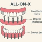 All-on-X
